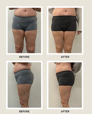 Functional Medicine Toms River NJ Celluma Body Contouring Before and After photos of a Celluma body contour patient. After treatment, they are more toned.